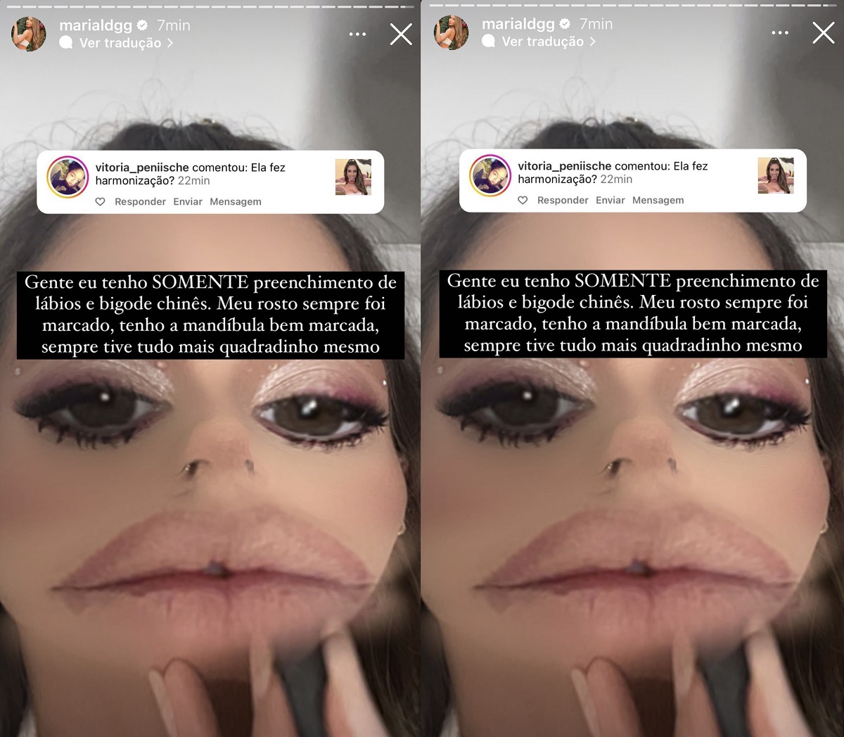 Maria Lina nega que tenha feito harmonização facial (Foto: Reprodução/Instagram)