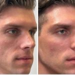 Outra harmonização facial desaprovada? Cristian, ex-BBB23, posta antes e depois: “Nem parece que fez nada”