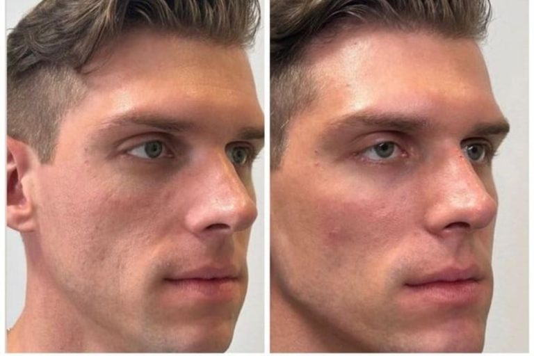 Outra harmonização facial desaprovada? Cristian, ex-BBB23, posta antes e depois: “Nem parece que fez nada”