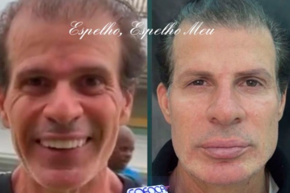 Túlio Maravilha faz harmonização facial e surpreende na internet; veja como ficou