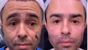 Diones Coelho ‘surfa’ na fama de Kayky Brito e ganha até harmonização facial; veja