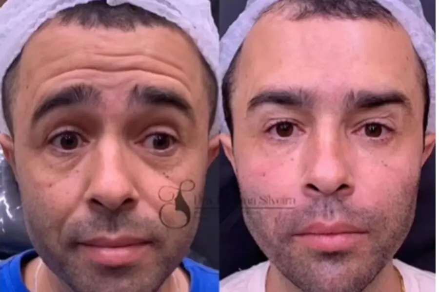 Diones Coelho ‘surfa’ na fama de Kayky Brito e ganha até harmonização facial; veja